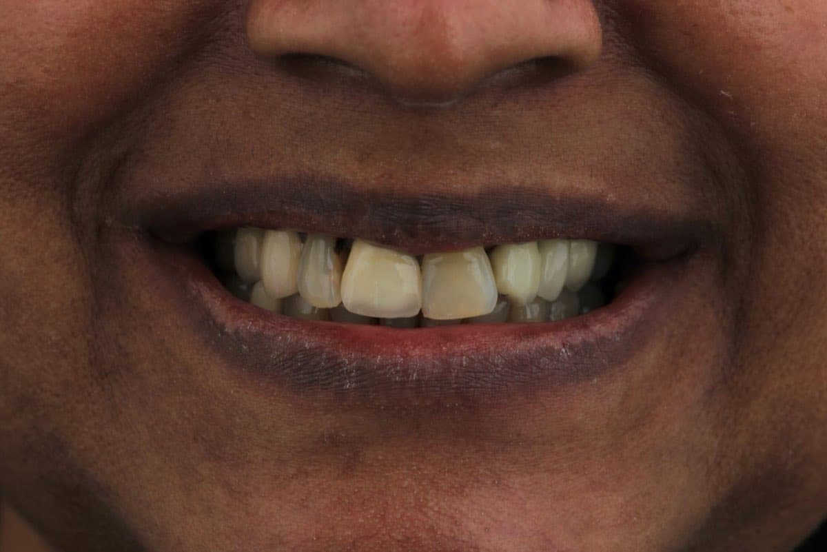 Before treatment