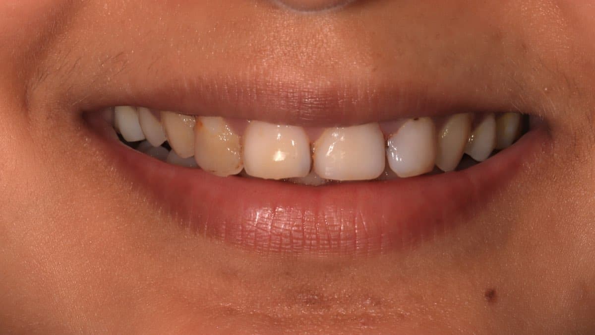 Before treatment