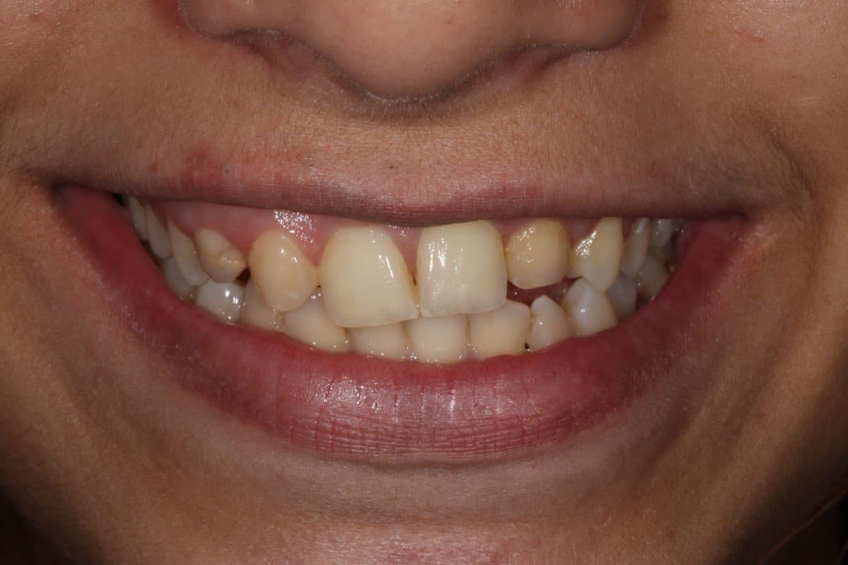 Before treatment
