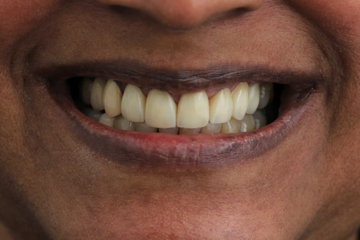 After treatment