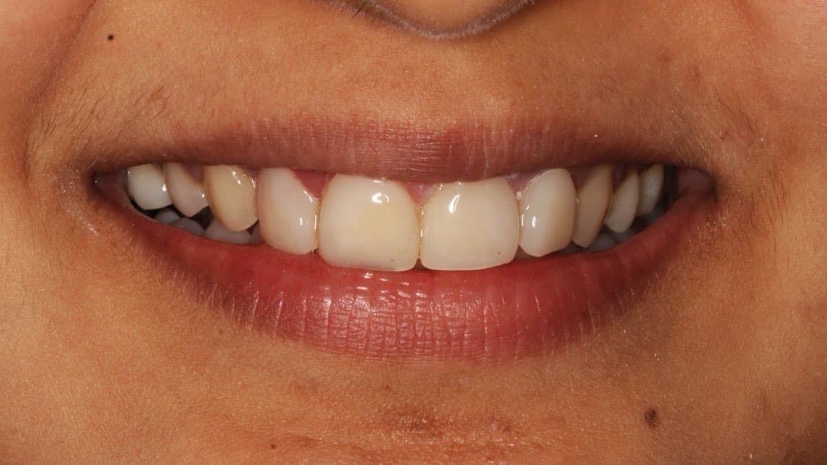 After treatment