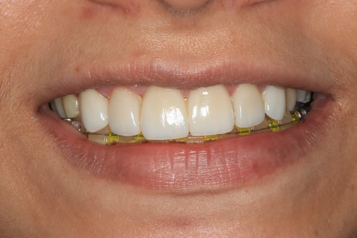 After treatment